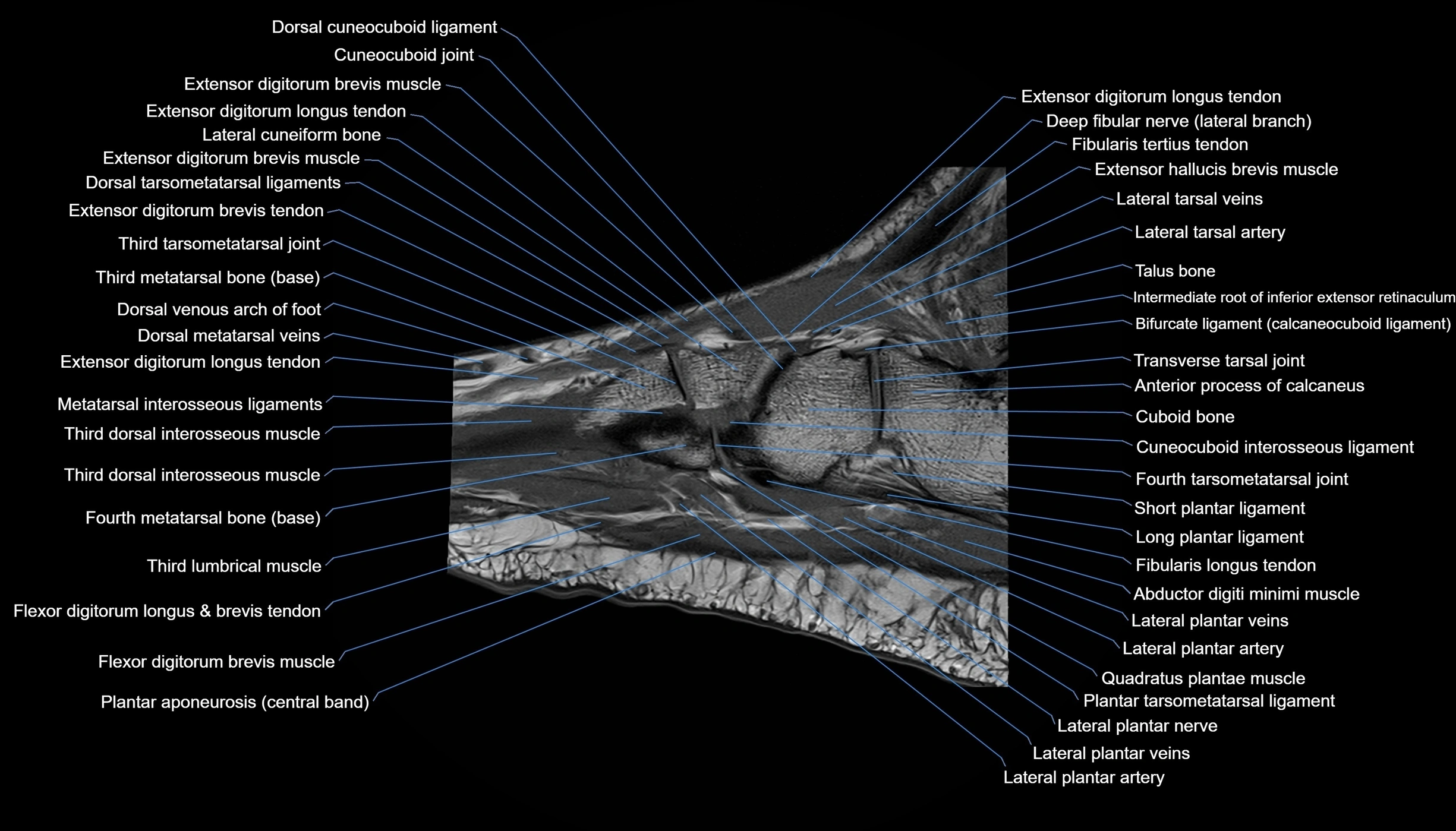 MRI mid foot sagittal cross sectional anatomy 3T  radiology  image-img-00001-00016.webp